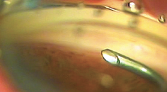 Early Experience With the OMNI Surgical System