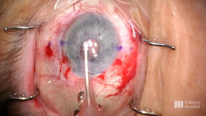 Corneal Edema in the Context of an Anterior Chamber IOL thumbnail