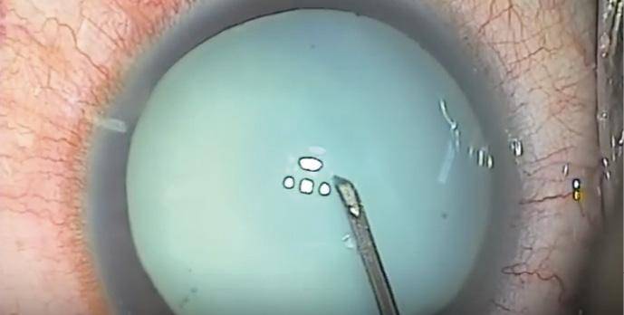 I Dont Have a Femtosecond Laser What Strategies Work Best for a White Cataract