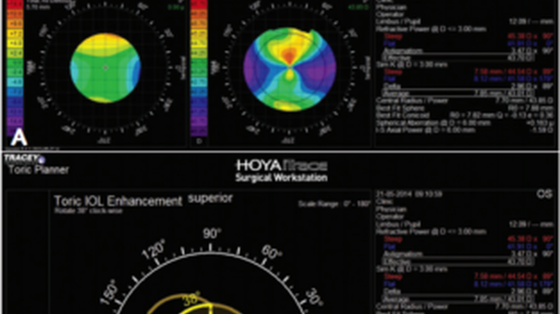 Advancing Cataract Surgery With Diagnostic Technologies