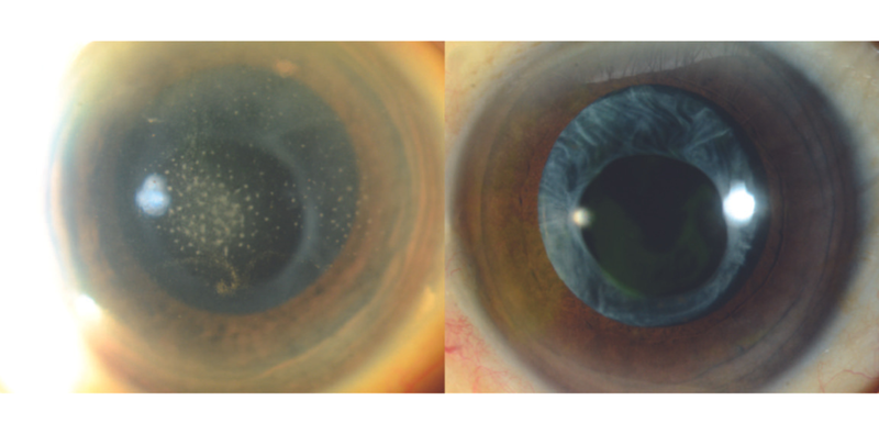 Treating Herpes Simplex and Varicella Anterior Uveitis