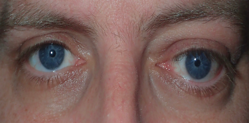 Managing Thyroid Eye Disease