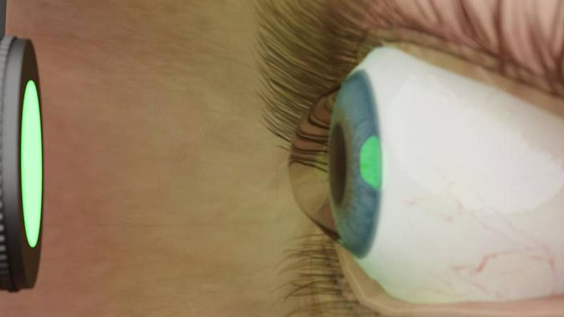 Keratoconus and Visual Rehabilitation