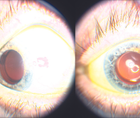 Premium IOL in an Eye With a History of Lattice Corneal Dystrophy