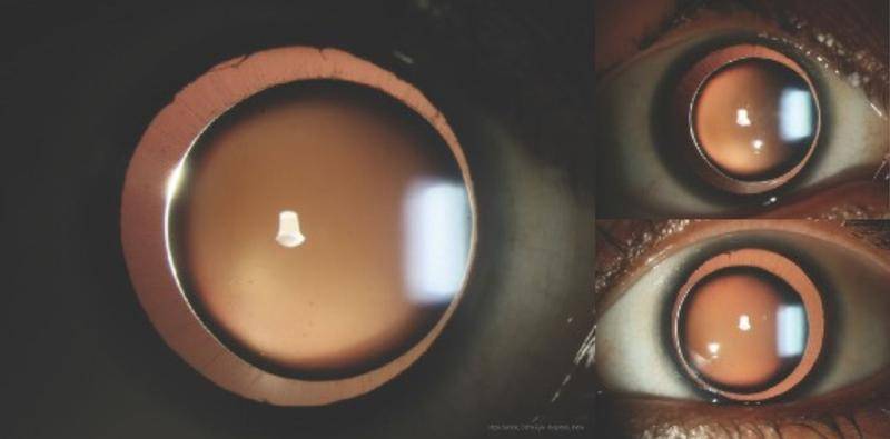 Bilateral Microspherophakia With High Myopia