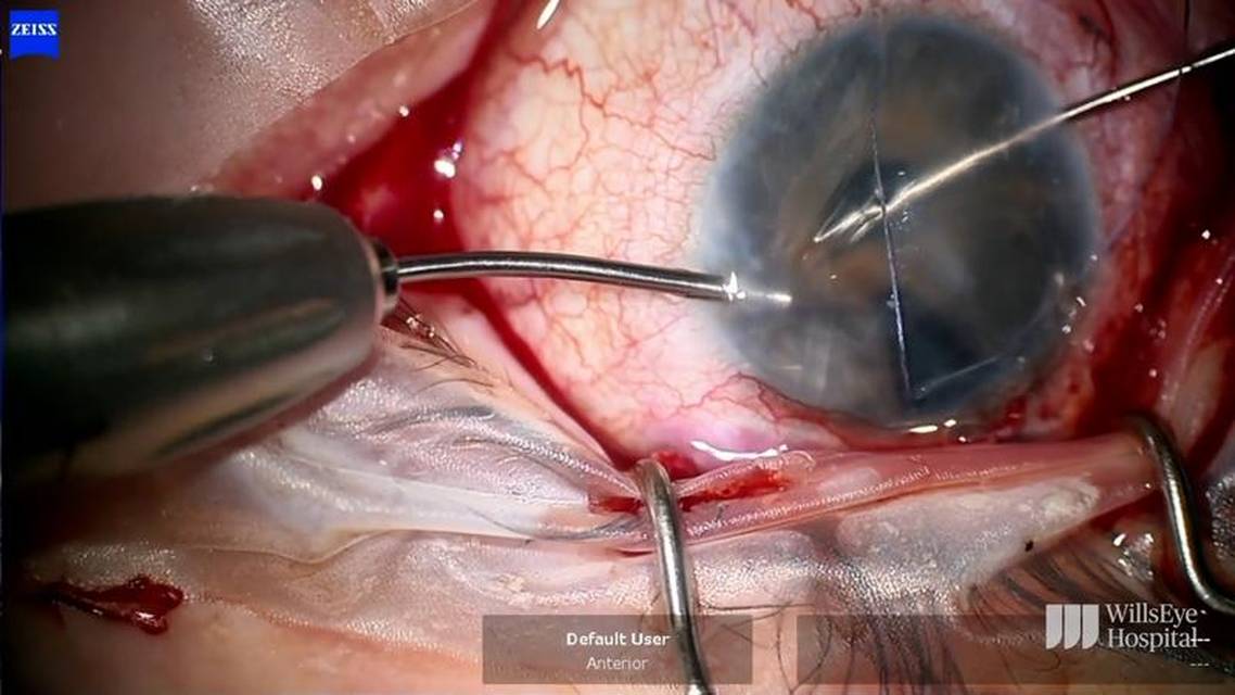 Tube Exchange in Uncontrolled Glaucoma thumbnail