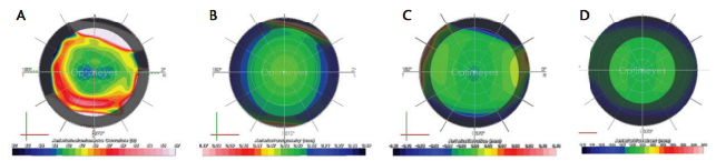 Optimization of Surgical Treatments in the Cornea