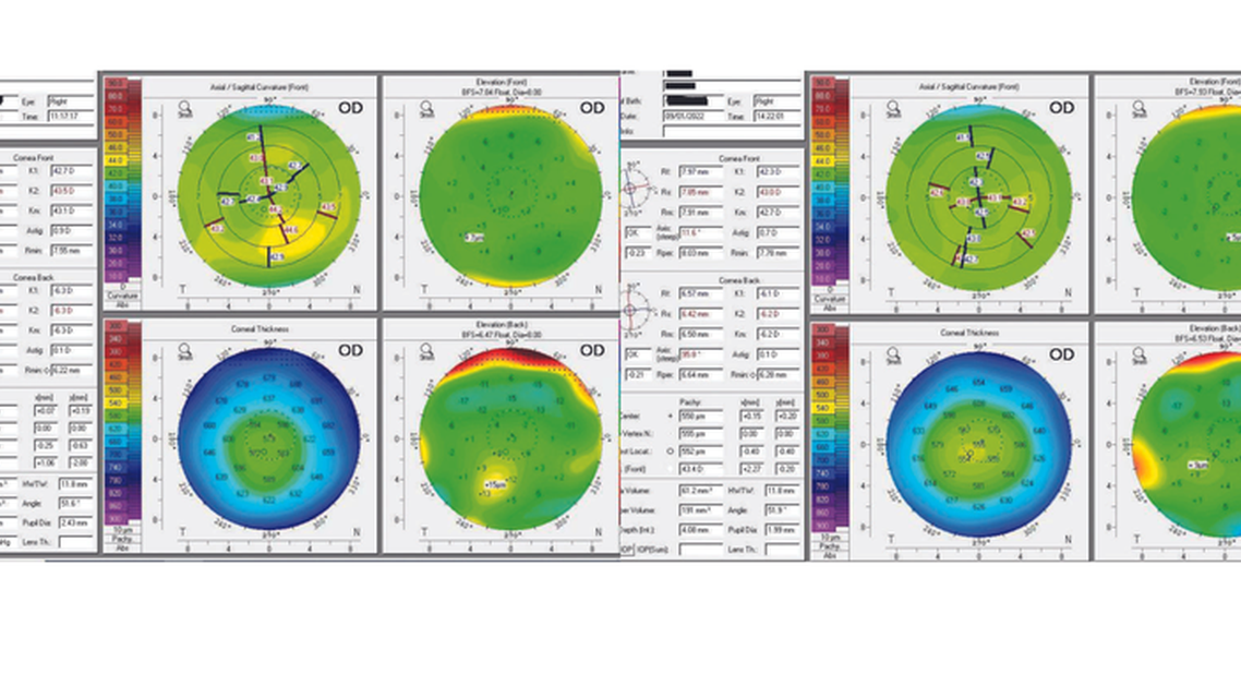 Persistently Blurred Vision After LASIK