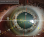 The Role of Iris Fingerprinting in Toric IOL Alignment