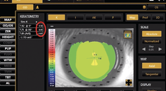Elevating Your Orthokeratology Fitting Using Topography and Biometry for Myopia Control
