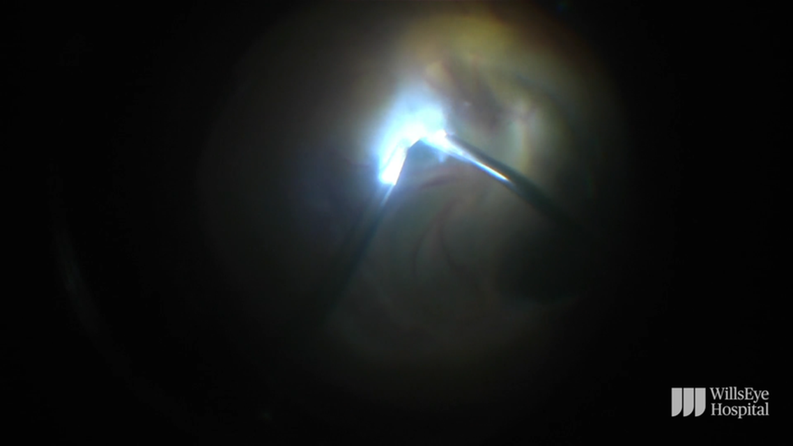 Surgery for an Infant With Stage5 Familial Exudative Vitreoretinopathy thumbnail