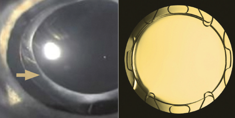 The FEMTIS IOL FamilyThe Perfect Match for FLACS Procedures