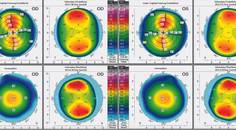 High Myopic Astigmatism