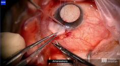 Choroidal Drainage and Repair of Bleb Leak thumbnail