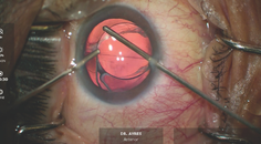 Postoperative Anisometropia