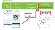 Refractive Astigmatism Outcomes With the Abulafia Koch Formula