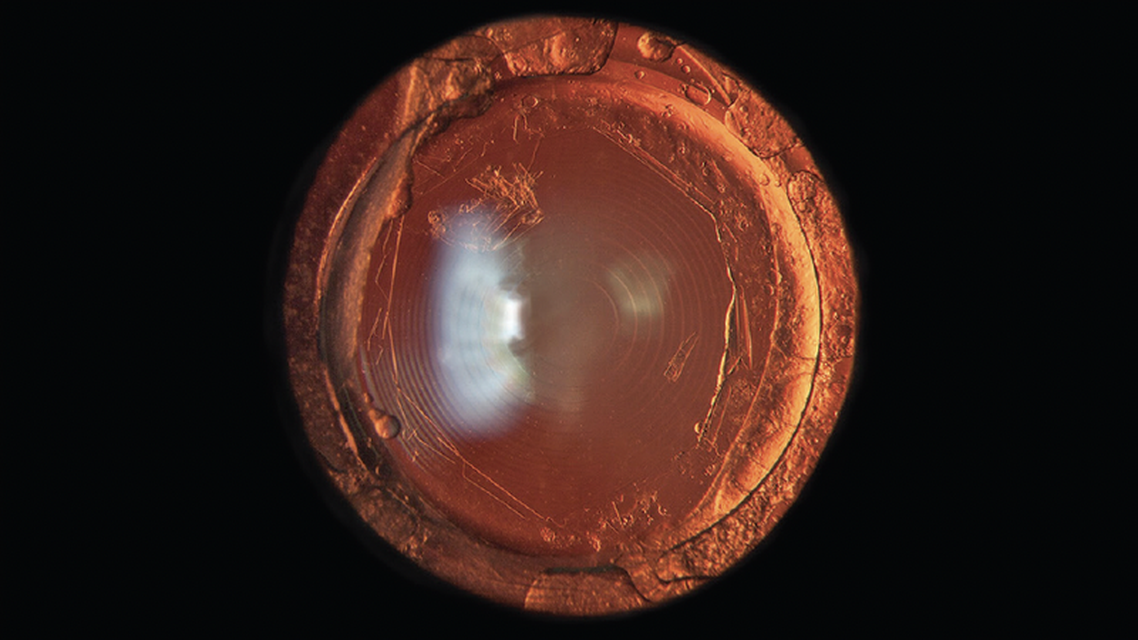 The YAG Capsulotomy The Final Hurdle to a Premium Visual Outcome