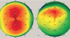 Preoperative Steps in Presbyopic Cataract Surgery