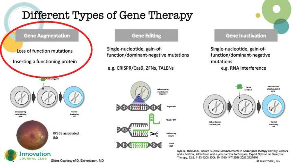 Gene Therapy for the Retina