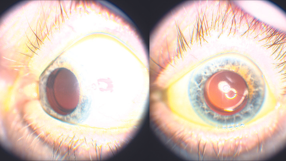 Premium IOL in an Eye With a History of Lattice Corneal Dystrophy