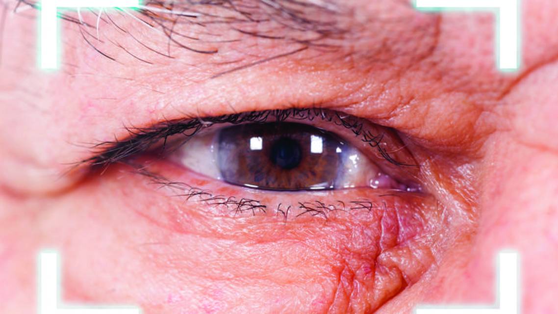 Secondary IOL Implantation After Complicated Primary Surgery