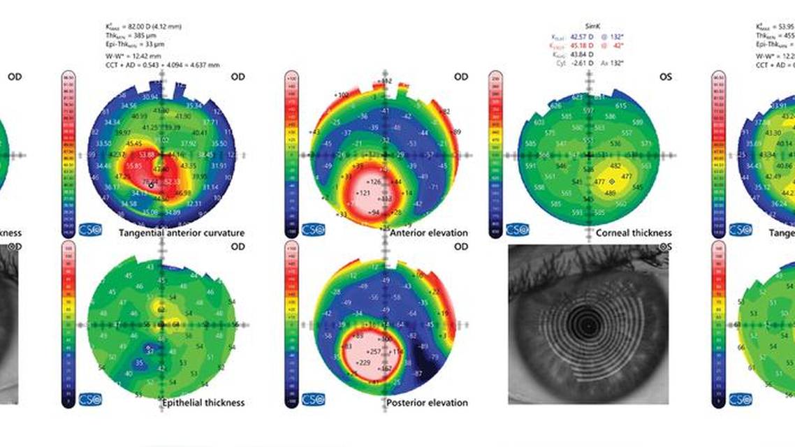 Cataract Surgery on Keratoconic Eyes