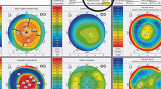 Cataracts After Monovision LASIK