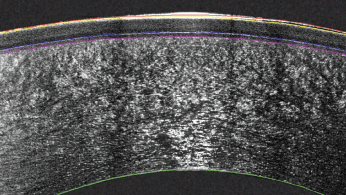 Layer by Layer Multi Zonal Thickness Mapping Unlocks a New Dimension in Corneal Diagnostics