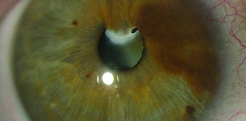 Congenital Cataract With Vascular Synechiae
