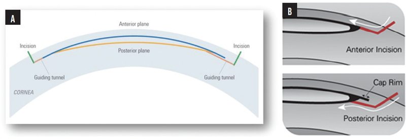 The CLEAR Advantage for Corneal Aberrations