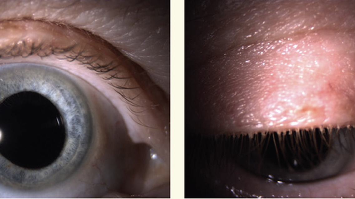 An Unexpected Cause of Keratoconus