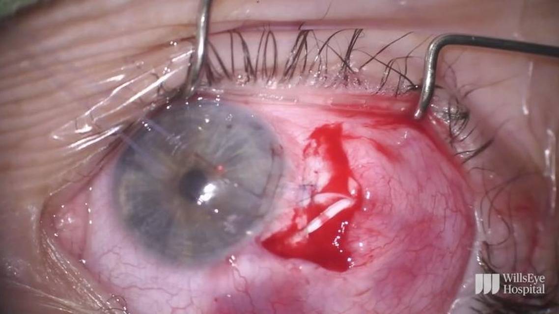 Intracorneal Tube Revision thumbnail