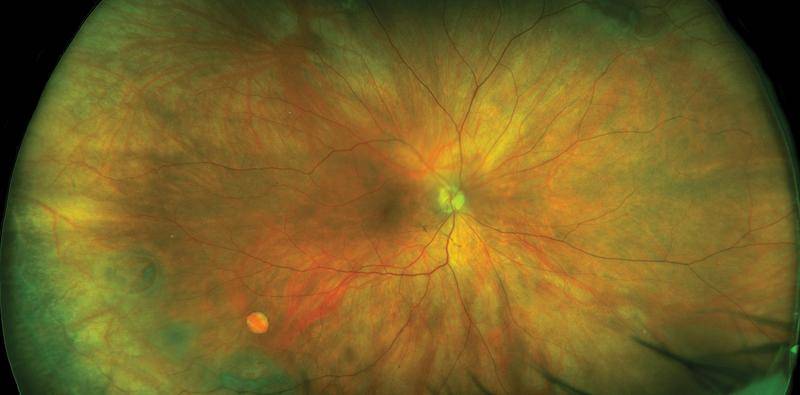 Use of UWF Retinal Imaging in Cataract Surgery