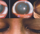 Nevus of Ota