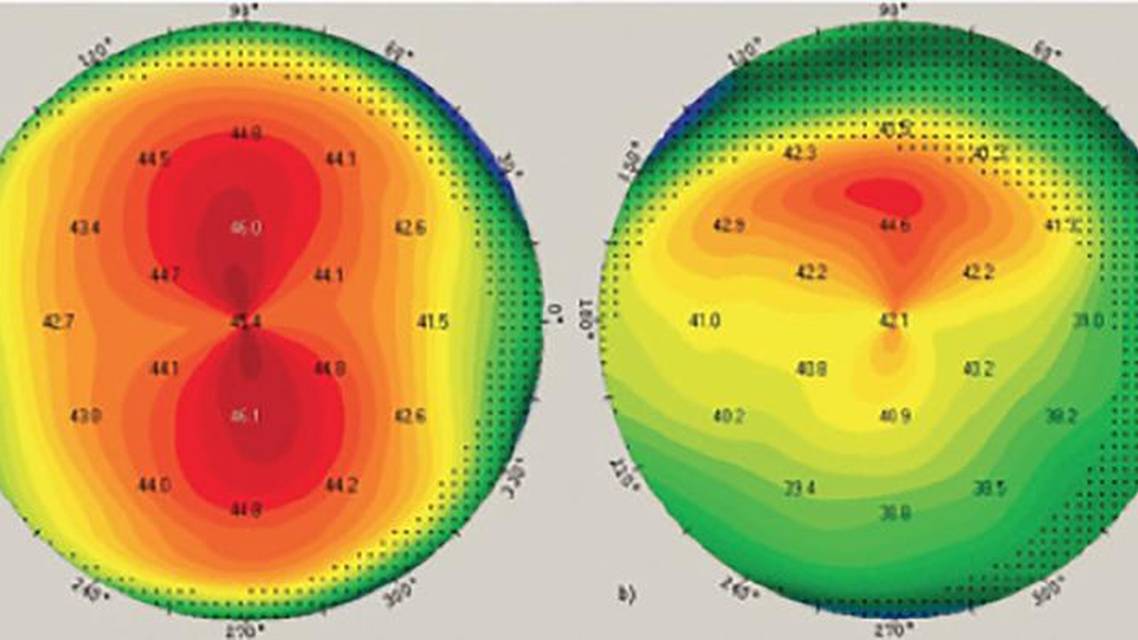 Preoperative Steps in Presbyopic Cataract Surgery