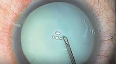 I Dont Have a Femtosecond Laser What Strategies Work Best for a White Cataract