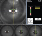 ATOS and SmartSight Current Trends and Procedural Volume