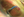 Figure 4. The microcatheter is removed, producing an ab-interno trabeculotomy.