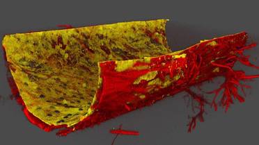 Cornell “Eye-on-a-Chip” Study Illuminates Pathway Behind Steroid-Induced Glaucoma image
