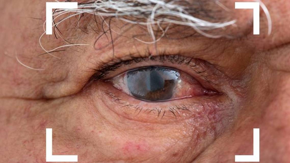 Chronic Inflammation After Cataract Surgery