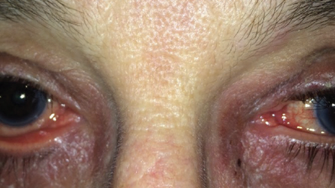 Early Intervention Is Best for Patients With Glaucoma