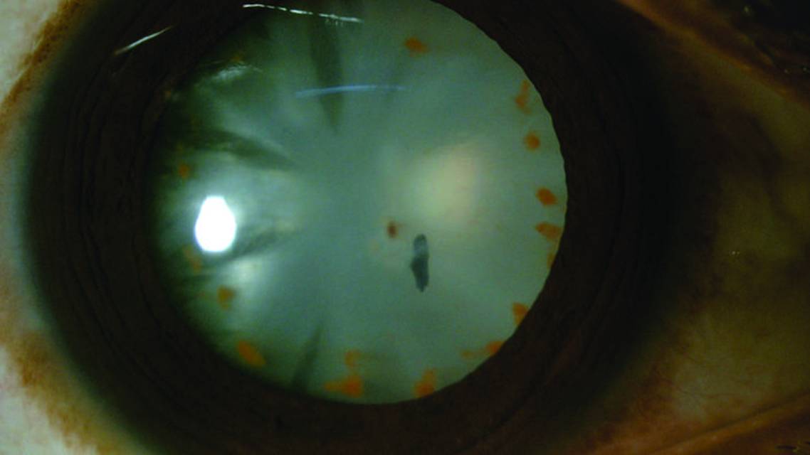 Intralenticular Iron Foreign Body With Lens Siderosis