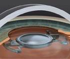 Precisight Multicomponent IOL