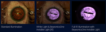 Beyeonics Vision Secures US Patent for Ophthalmic Surgical Visualization Technology image