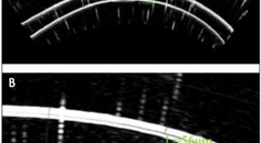 Epithelial Thickness An Indicator for Early Keratoconus