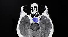 Ophthalmic Presentations of Pituitary Adenoma