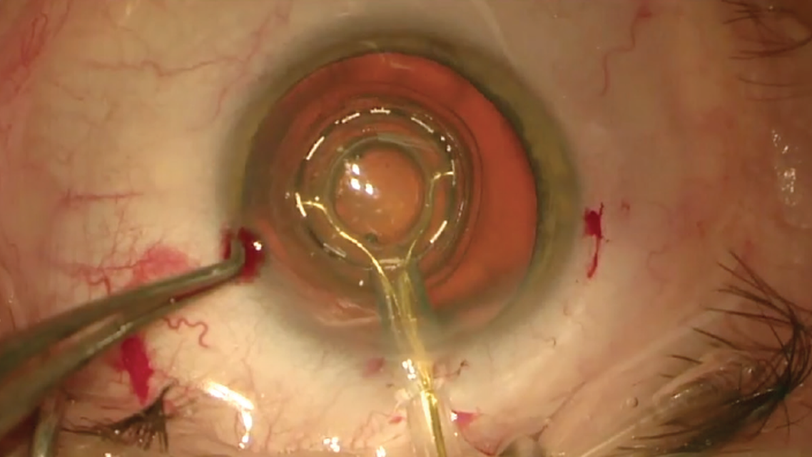 Zepto A viable Alternative to the Femtosecond Laser for FEMTIS IOL Implantation