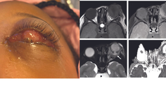 Endophthalmitis in a Patient With Presumed Axenfeld Rieger Syndrome
