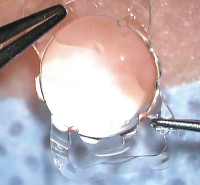 Cataract Case Studies With FEMTIS Mplus Toric IOLs