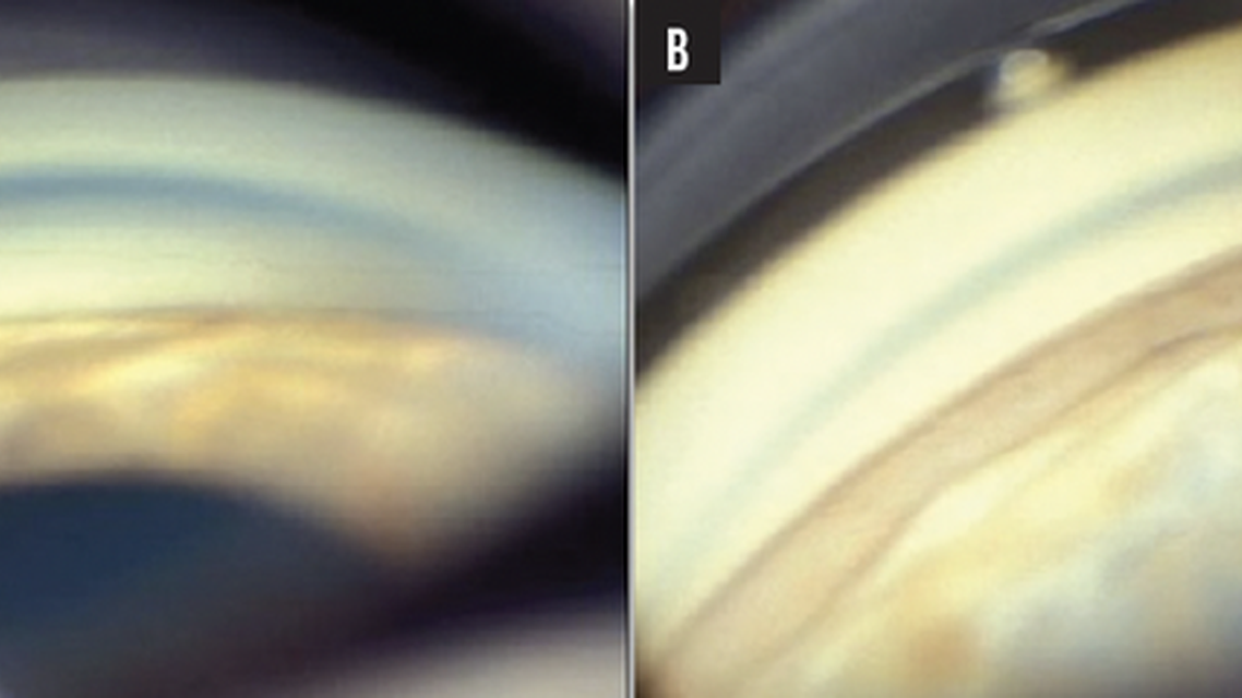 Trabecular Micro Bypass Surgery for the Management of Glaucoma